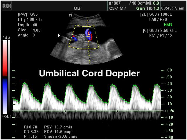 fetal doppler scan