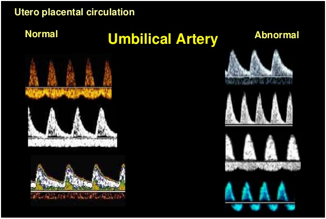 Umbilical artery Doppler scan