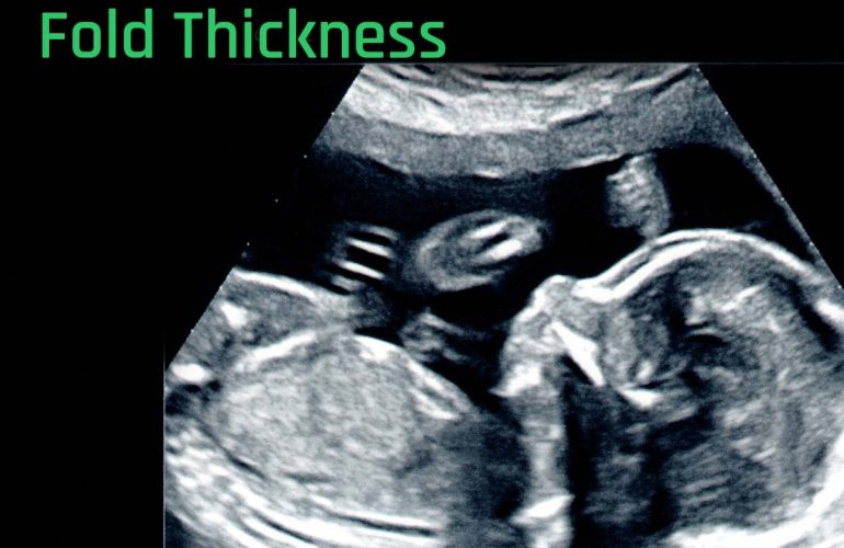 normal nuchal fold thickness
