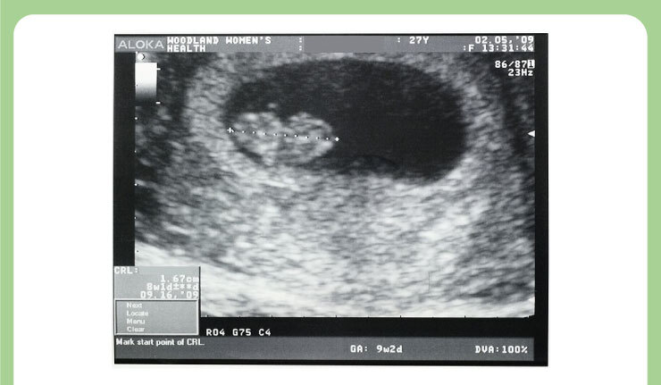 Baby in ultrasound scan